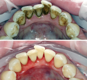 Професійне чищення зубів